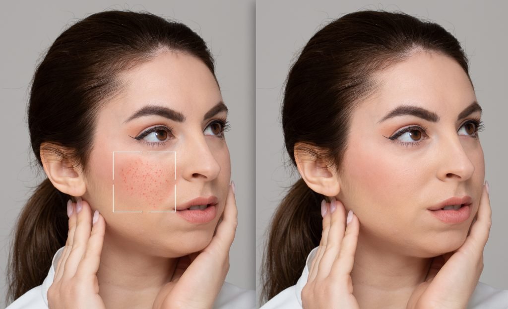 face of girl suffering from rosacea before and after a treats